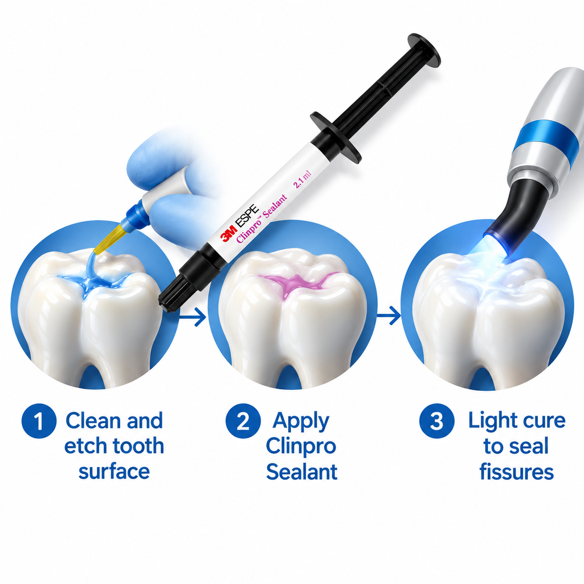 3m Espe Clinpro Sealant - Refills