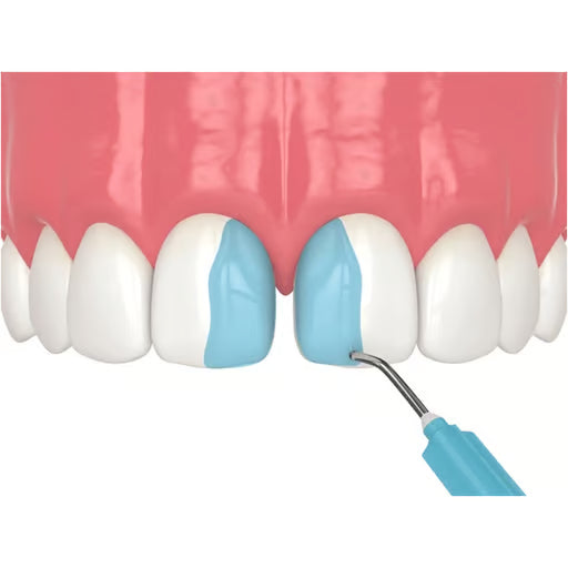 Ivoclar N Etchant Gel 2g