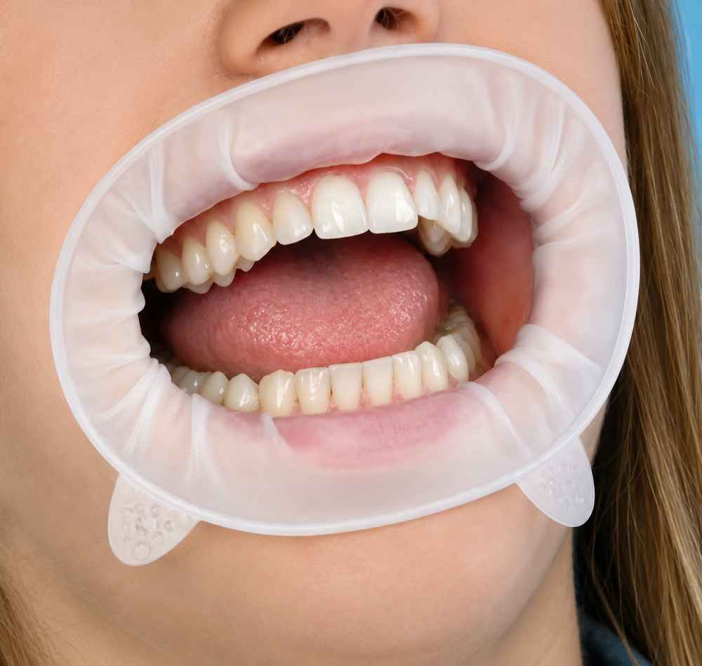 Ivoclar Optragate Cheek And Lip Retractor