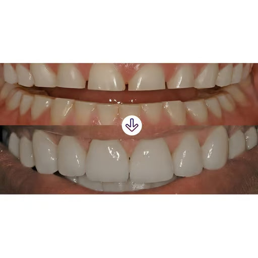 3m Espe Relyx Veneer Cement