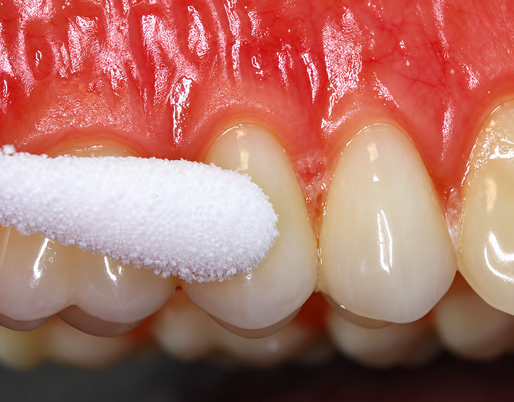 Coltene Vitality Control Endo-Frost For tooth Vitality test