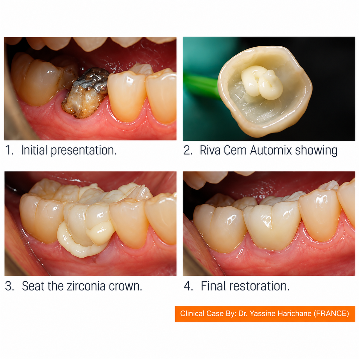 Sdi Dental Riva Cem Automix - Resin-Based Glass Ionomer Cement 2*4 g