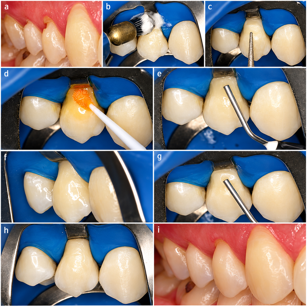 Spident EsFlow Light-Cured Flowable Composite Resin Syringes