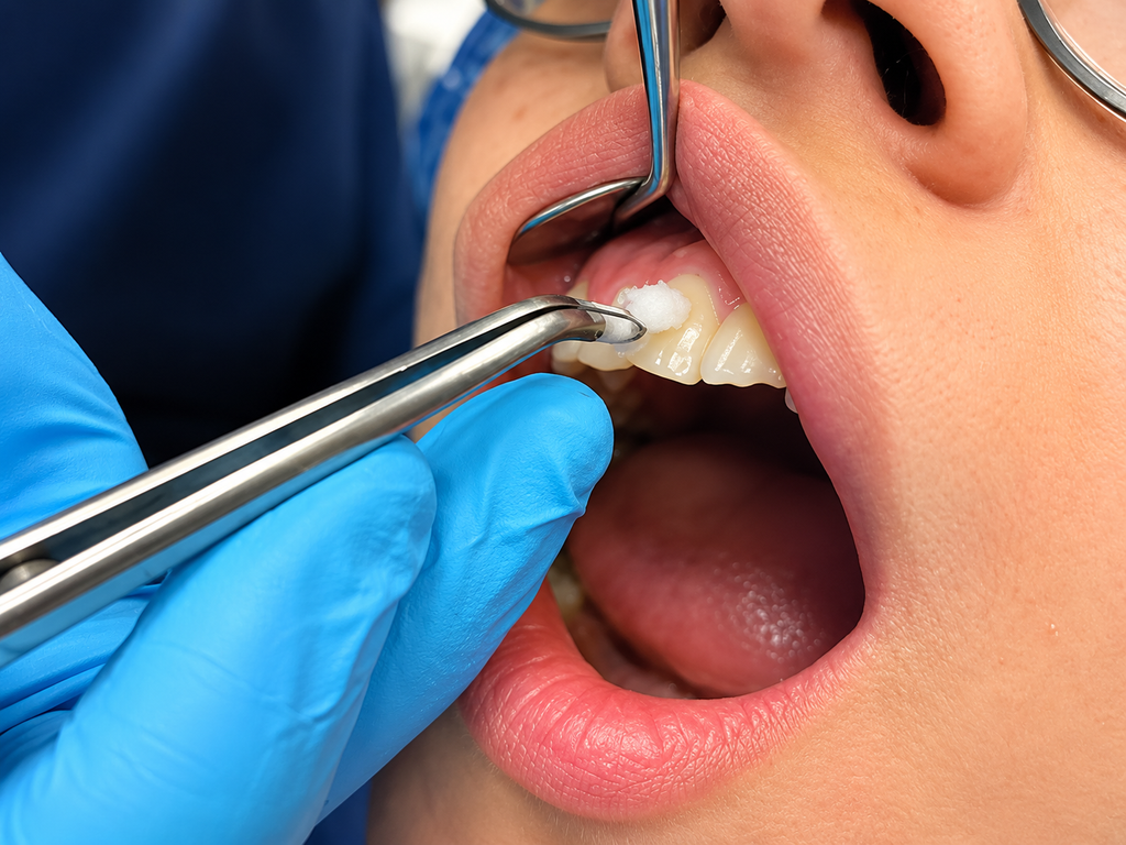 Coltene Vitality Control Endo-Frost For tooth Vitality test