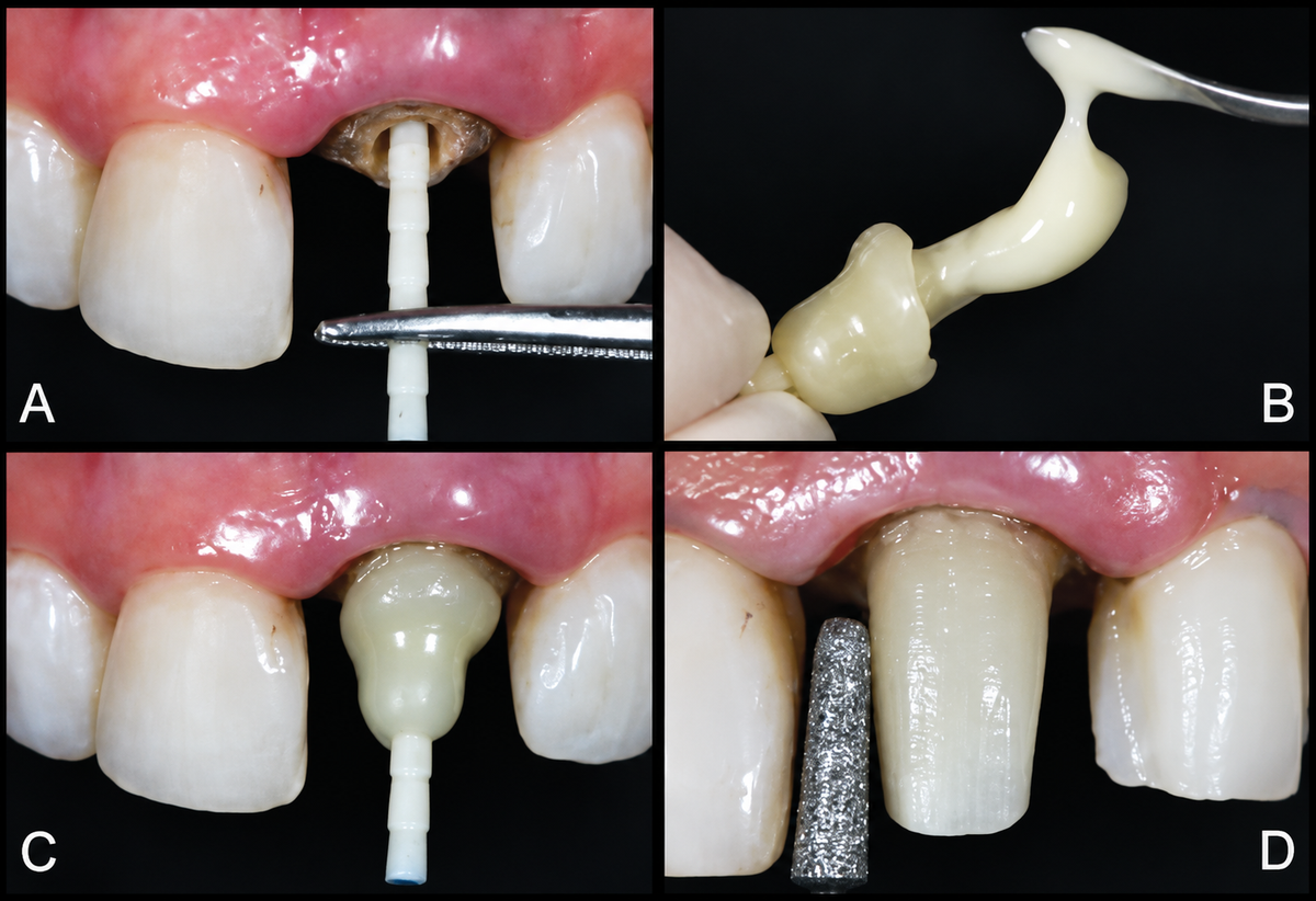 Prevest Denpro Fusion Core Dc Flo Core Build-up Material (9g)