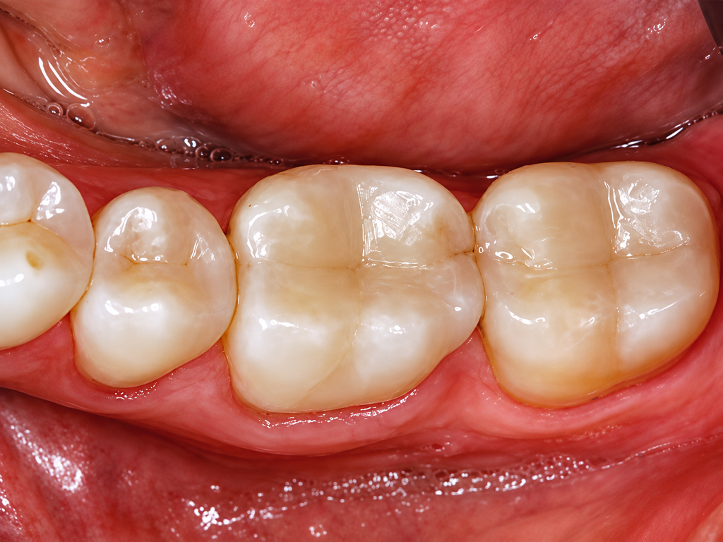 Ivoclar Vivadent Tetric N-Ceram Bulk Fill Syringe